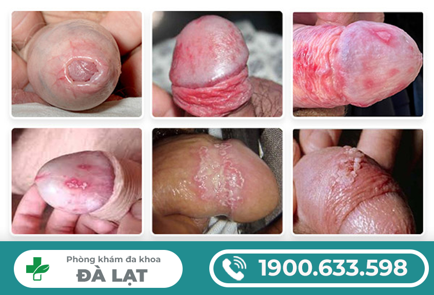 VIÊM NHIỄM Ở ĐẦU KHẤC